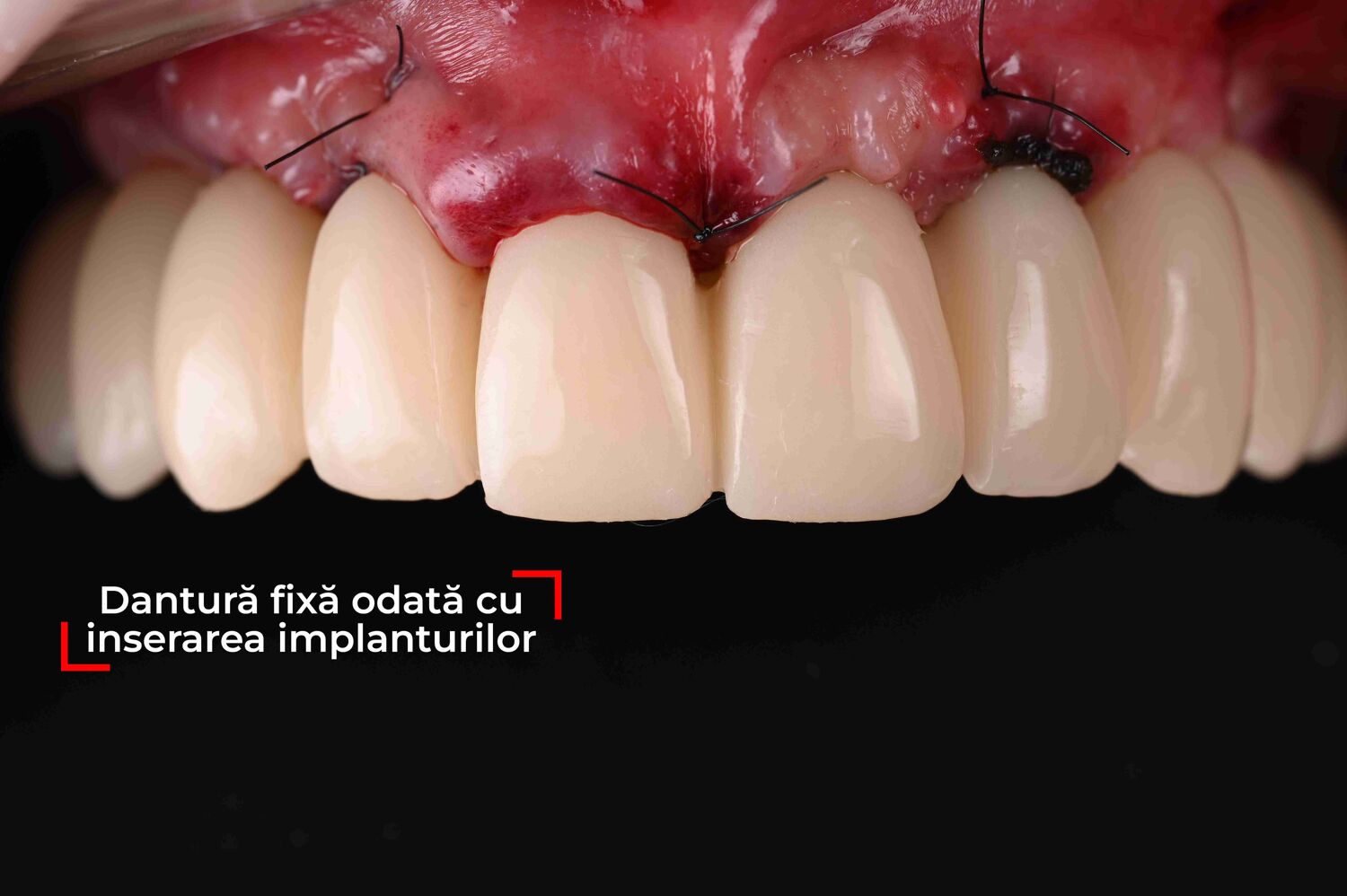 Dantură fixă provizorie aplicată imediat postoperator